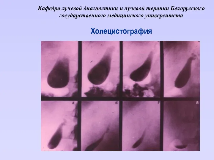 Кафедра лучевой диагностики и лучевой терапии Белорусского государственного медицинского университета Холецистография