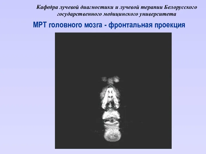 Кафедра лучевой диагностики и лучевой терапии Белорусского государственного медицинского университета МРТ головного мозга - фронтальная проекция