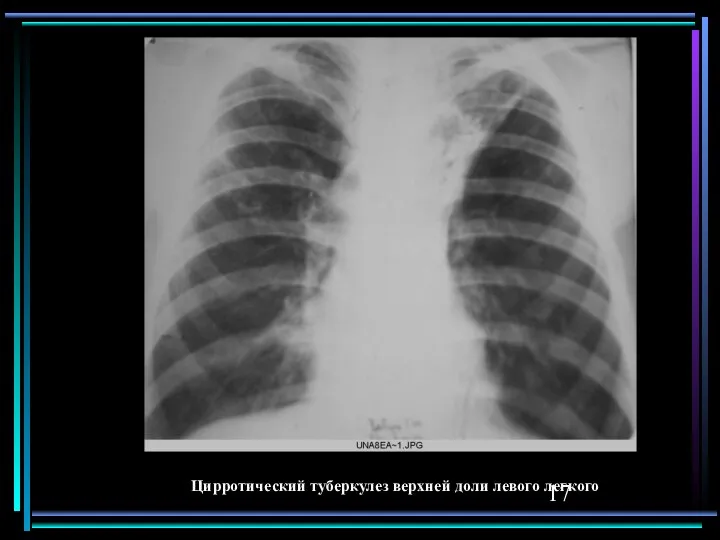 Цирротический туберкулез верхней доли левого легкого