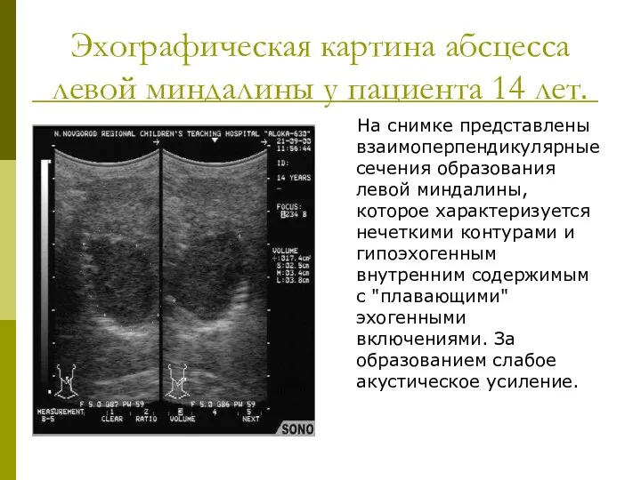 Эхографическая картина абсцесса левой миндалины у пациента 14 лет. На снимке