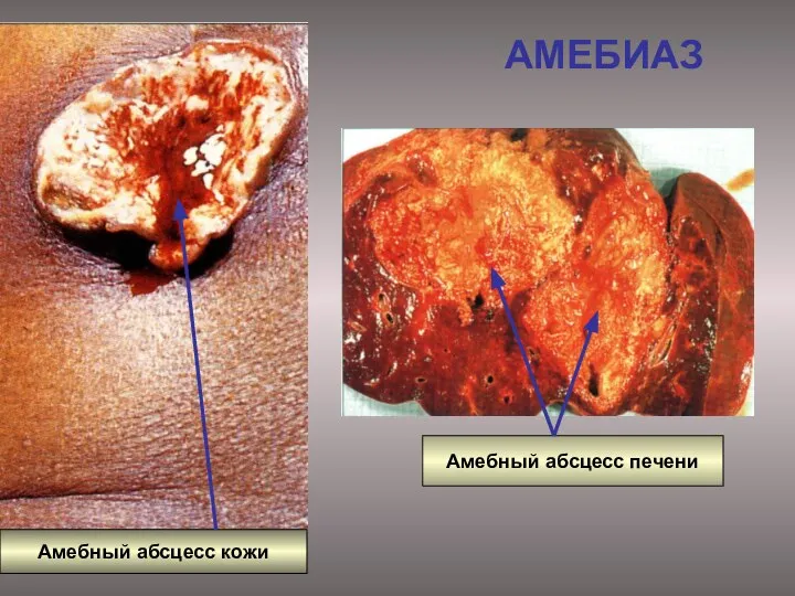 АМЕБИАЗ Амебный абсцесс печени Амебный абсцесс кожи