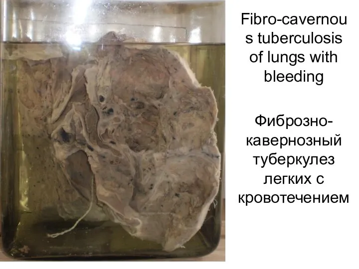 Fibro-cavernous tuberculosis of lungs with bleeding Фиброзно-кавернозный туберкулез легких с кровотечением