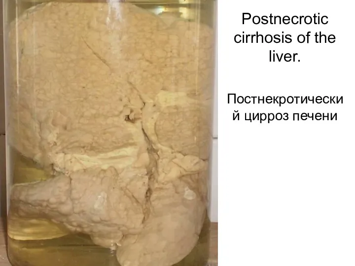 Postnecrotic cirrhosis of the liver. Постнекротический цирроз печени