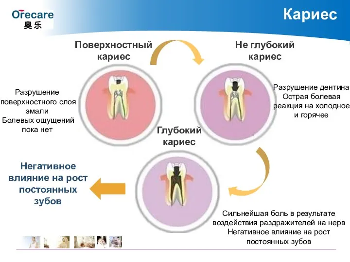 Разрушение поверхностного слоя эмали Болевых ощущений пока нет Разрушение дентина. Острая