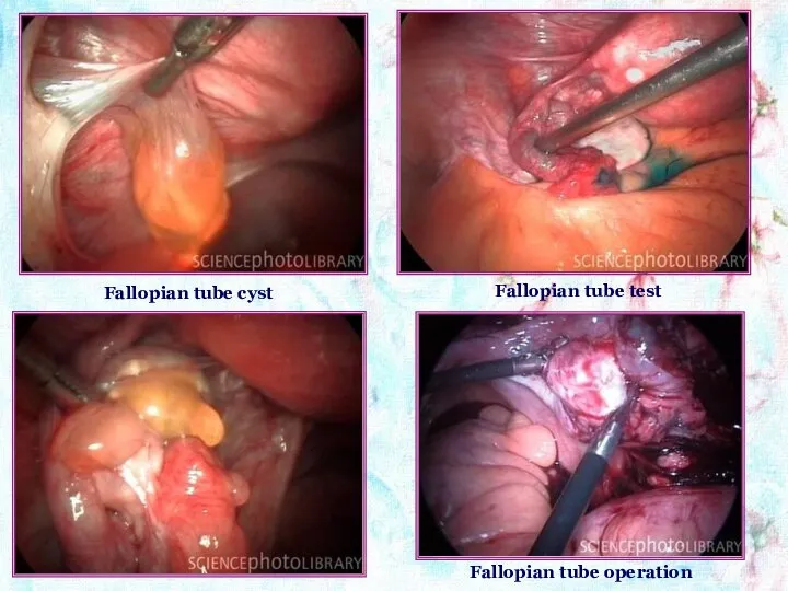 Fallopian tube cyst Fallopian tube test Fallopian tube operation