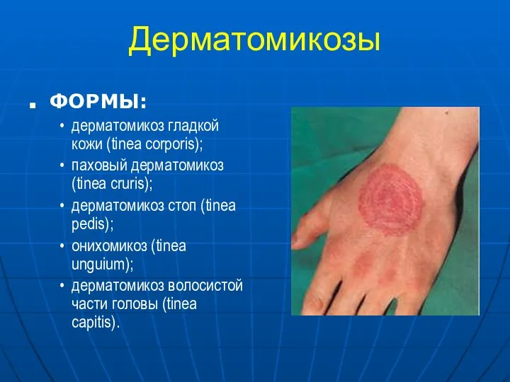 Дерматомикозы ФОРМЫ: дерматомикоз гладкой кожи (tinea corporis); паховый дерматомикоз (tinea cruris);