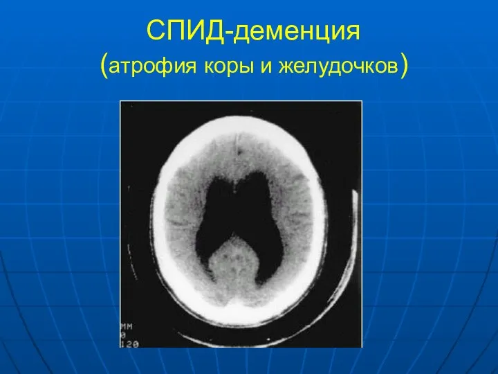 СПИД-деменция (атрофия коры и желудочков)