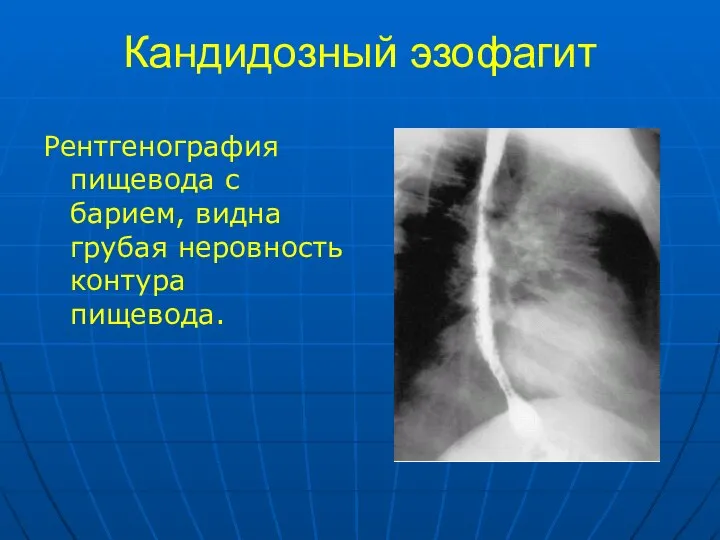 Кандидозный эзофагит Рентгенография пищевода с барием, видна грубая неровность контура пищевода.