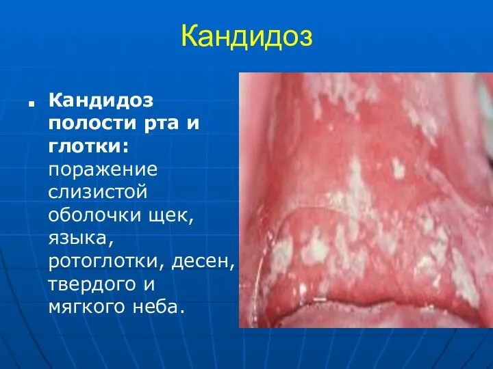 Кандидоз Кандидоз полости рта и глотки: поражение слизистой оболочки щек, языка,