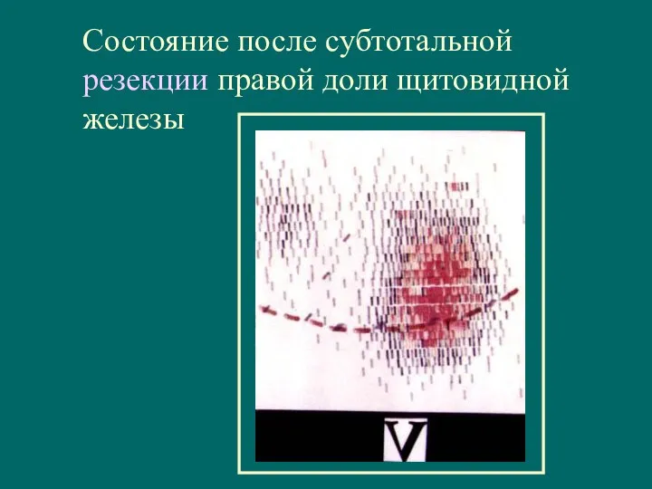 Состояние после субтотальной резекции правой доли щитовидной железы