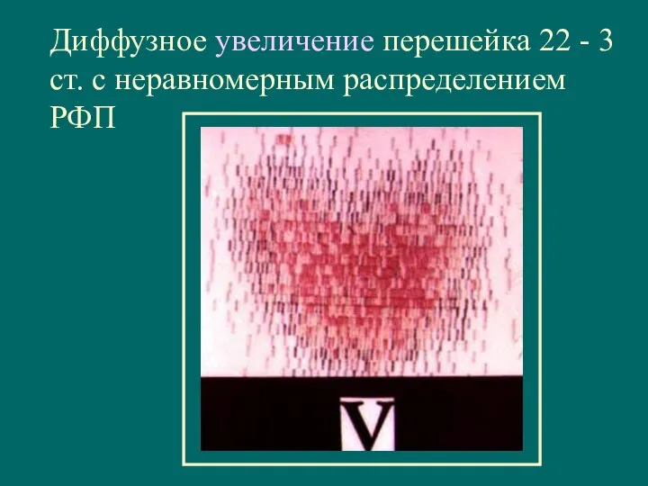 Диффузное увеличение перешейка 22 - 3 ст. с неравномерным распределением РФП