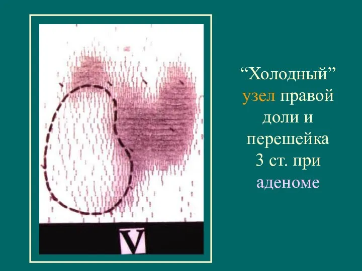 “Холодный” узел правой доли и перешейка 3 ст. при аденоме