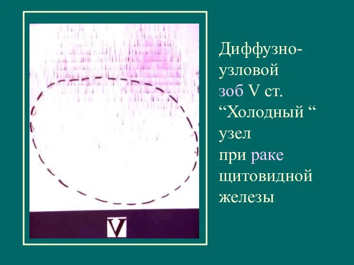 Диффузно-узловой зоб V ст. “Холодный “ узел при раке щитовидной железы