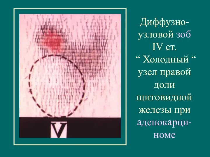 Диффузно-узловой зоб IV ст. “ Холодный “ узел правой доли щитовидной железы при аденокарци-номе