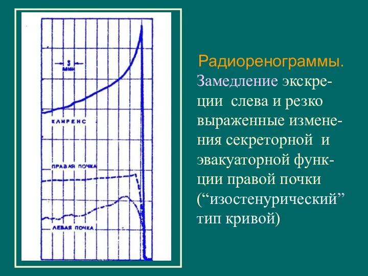 Радиоренограммы. Замедление экскре-ции слева и резко выраженные измене-ния секреторной и эвакуаторной