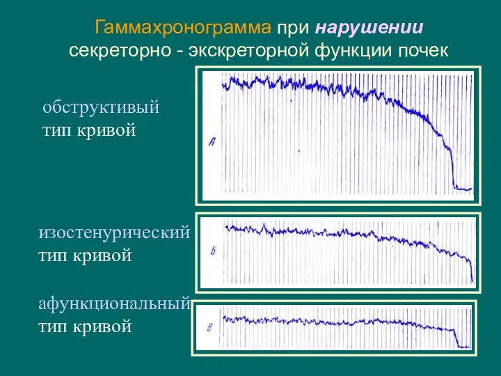 Гаммахронограмма при нарушении секреторно - экскреторной функции почек обструктивый тип кривой