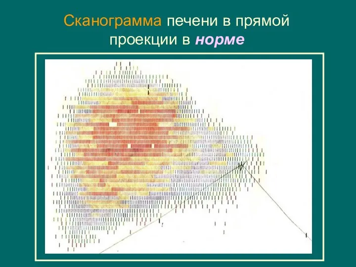 Сканограммa печени в прямой проекции в норме