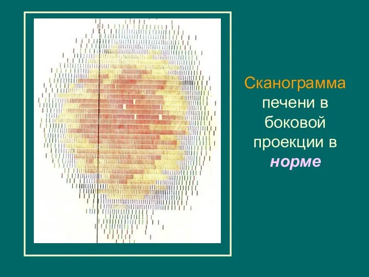 Сканограммa печени в боковой проекции в норме