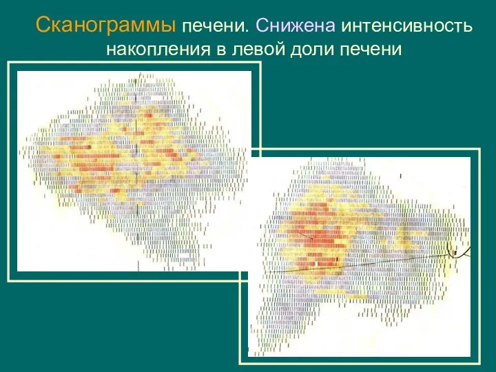 Сканограммы печени. Снижена интенсивность накопления в левой доли печени