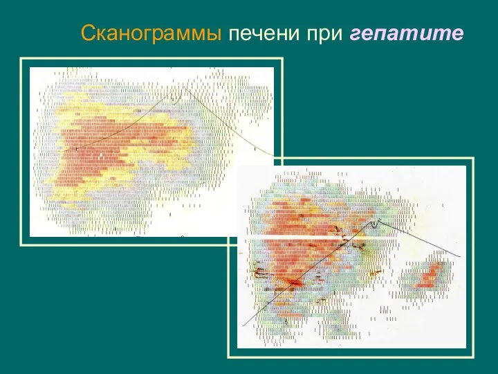 Сканограммы печени при гепатите