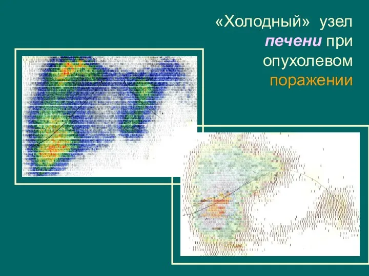 «Холодный» узел печени при опухолевом поражении