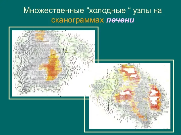 Множественные “холодные “ узлы на сканограммах печени