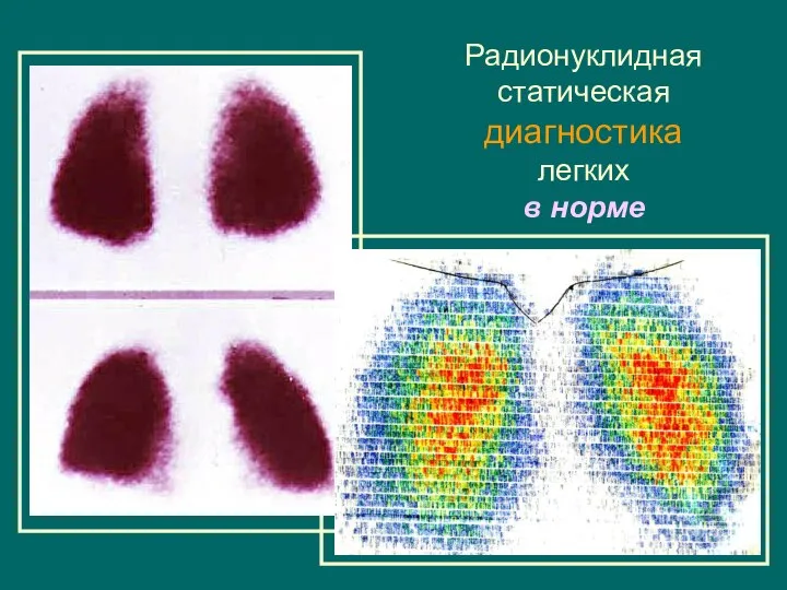 Радионуклидная статическая диагностика легких в норме