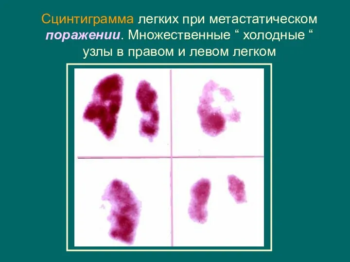 Сцинтиграмма легких при метастатическом поражении. Множественные “ холодные “ узлы в правом и левом легком