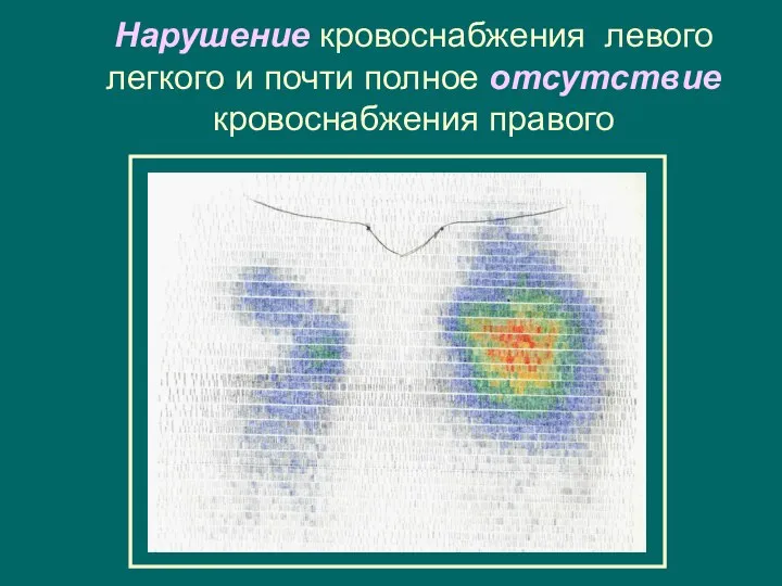 Нарушение кровоснабжения левого легкого и почти полное отсутствие кровоснабжения правого