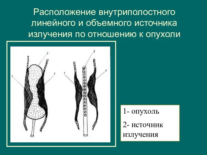 Расположение внутриполостного линейного и объемного источника излучения по отношению к опухоли 1- опухоль 2- источник излучения