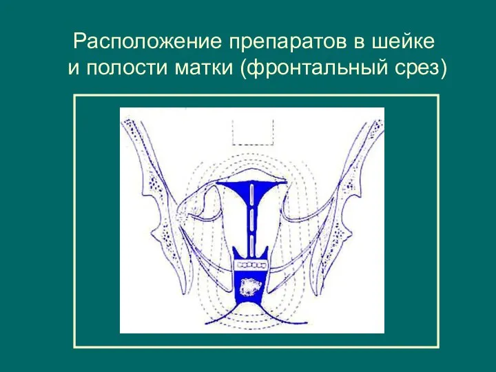 Расположение препаратов в шейке и полости матки (фронтальный срез)