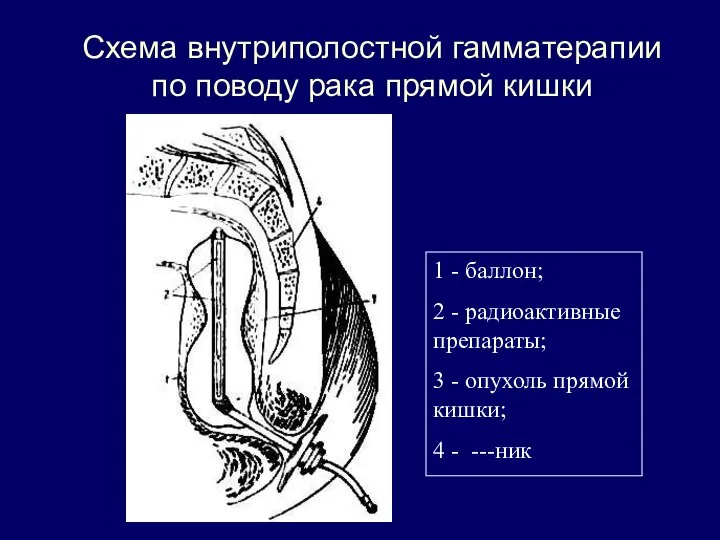 Схема внутриполостной гамматерапии по поводу рака прямой кишки 1 - баллон;