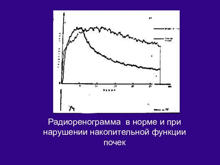 Радиоренограмма в норме и при нарушении накопительной функции почек