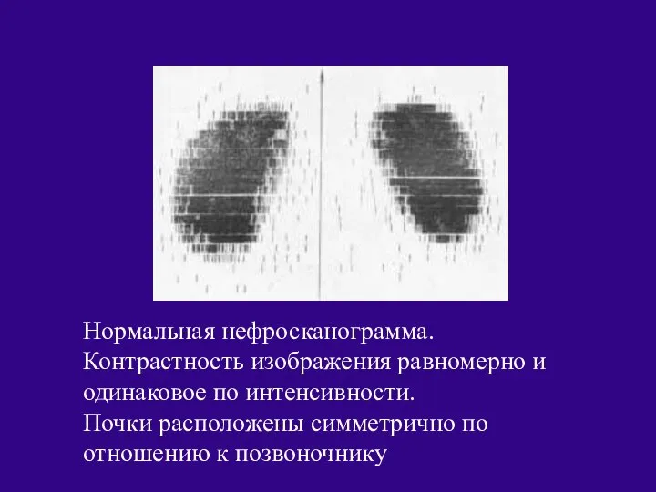 Нормальная нефросканограмма. Контрастность изображения равномерно и одинаковое по интенсивности. Почки расположены симметрично по отношению к позвоночнику