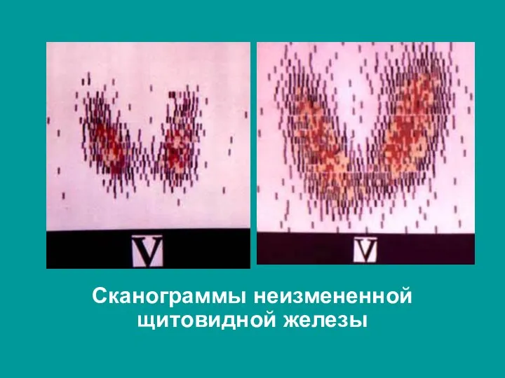 Сканограммы неизмененной щитовидной железы