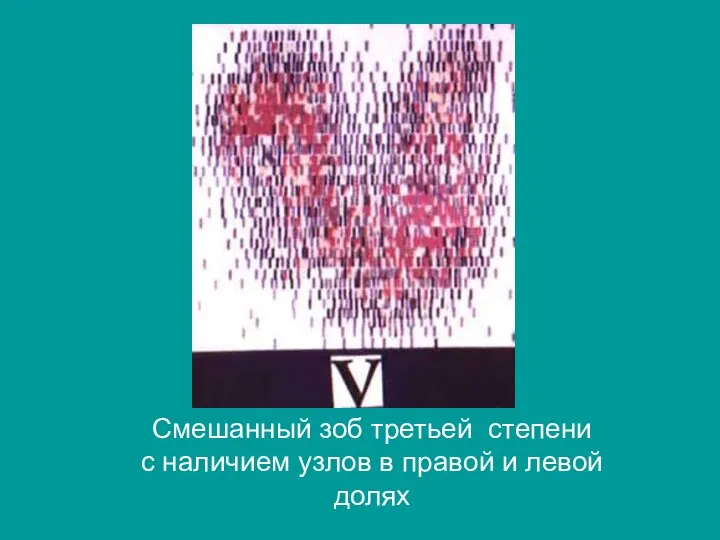 Смешанный зоб третьей степени с наличием узлов в правой и левой долях