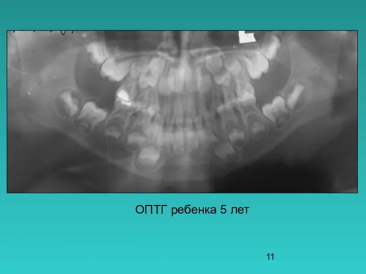 ОПТГ ребенка 5 лет