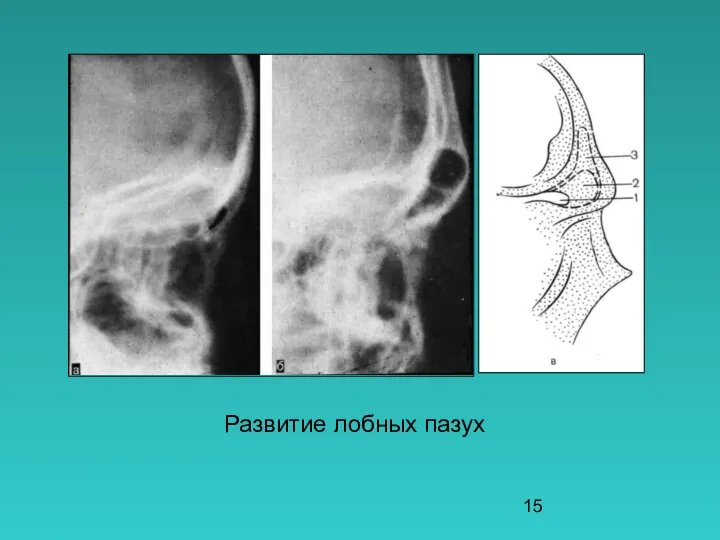 Развитие лобных пазух