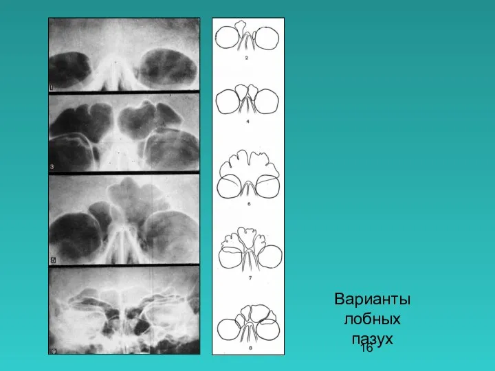 Варианты лобных пазух