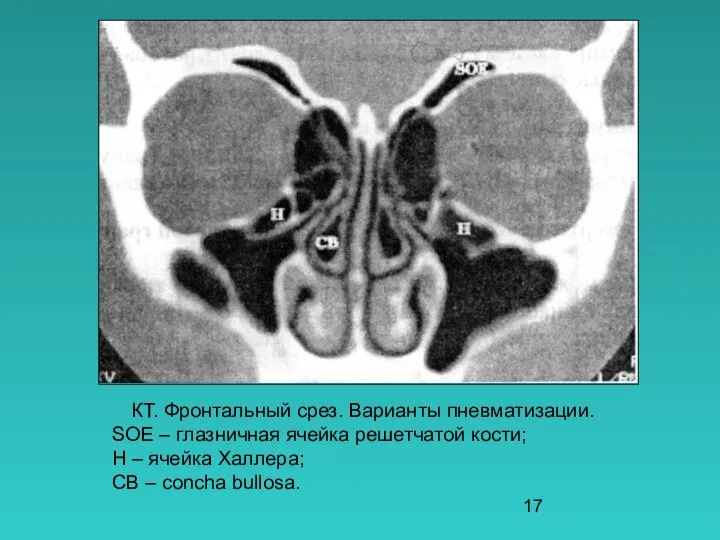 КТ. Фронтальный срез. Варианты пневматизации. SOE – глазничная ячейка решетчатой кости;