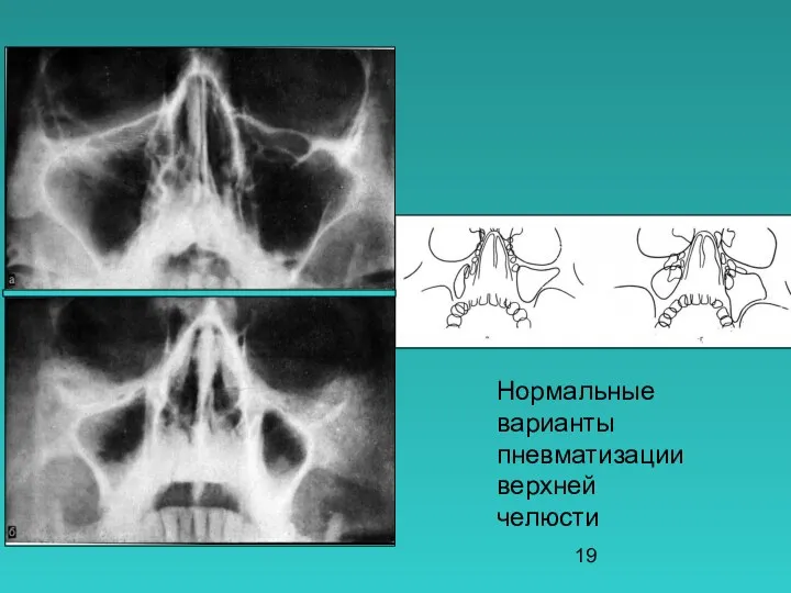 Нормальные варианты пневматизации верхней челюсти