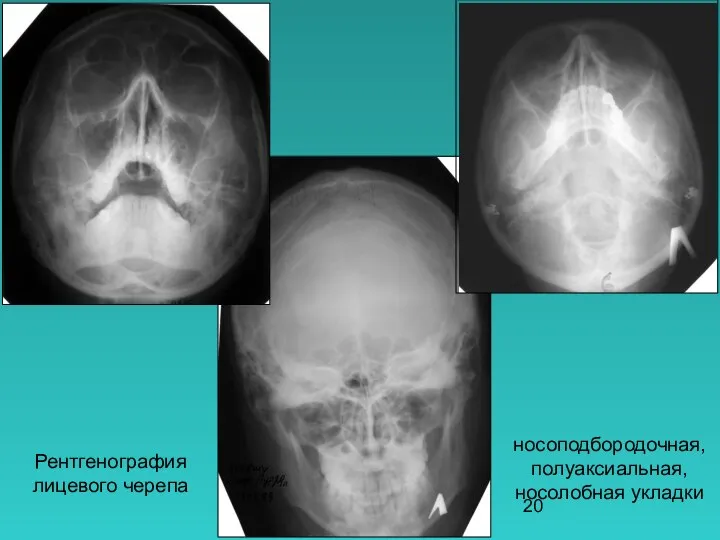 носоподбородочная, полуаксиальная, носолобная укладки Рентгенография лицевого черепа