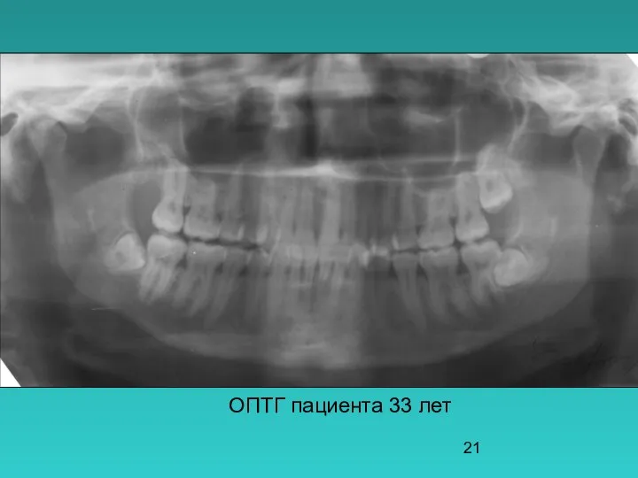 ОПТГ пациента 33 лет