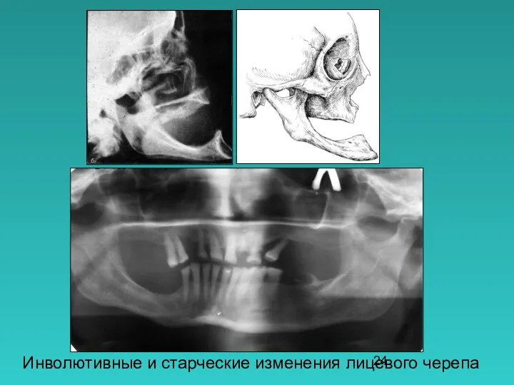 Инволютивные и старческие изменения лицевого черепа