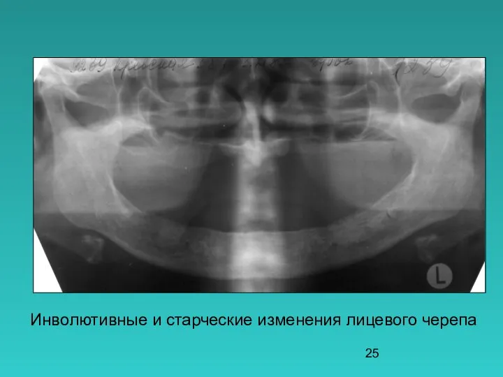 Инволютивные и старческие изменения лицевого черепа