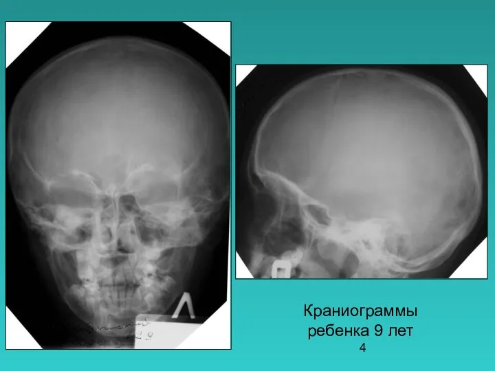 Краниограммы ребенка 9 лет