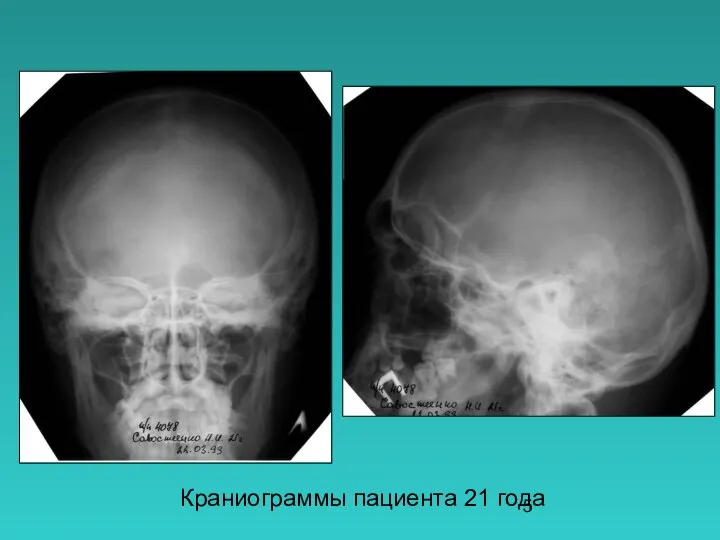 Краниограммы пациента 21 года