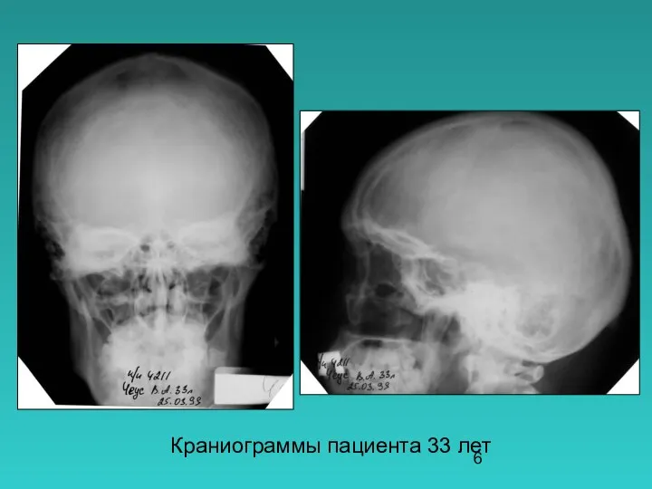 Краниограммы пациента 33 лет