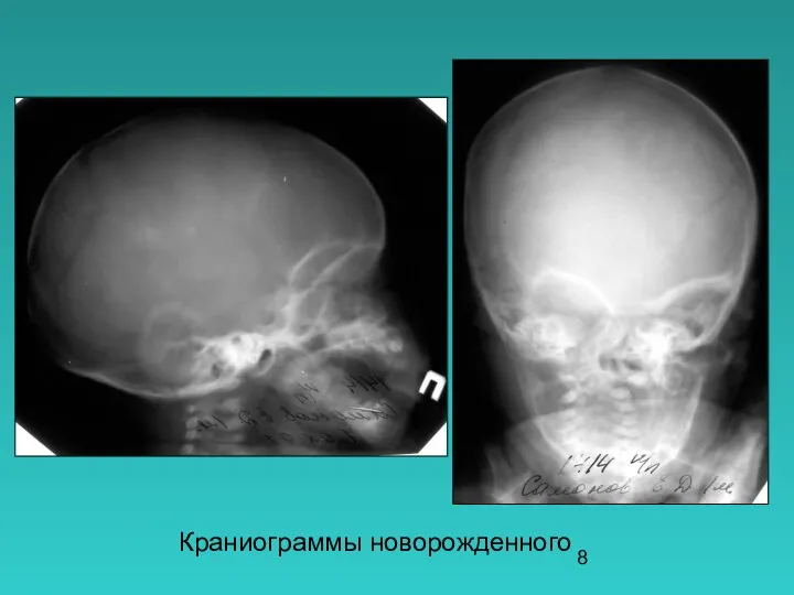 Краниограммы новорожденного