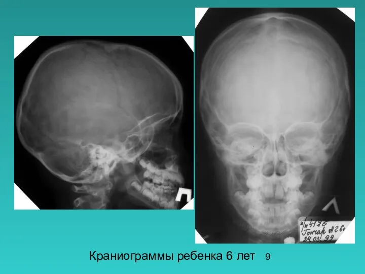 Краниограммы ребенка 6 лет